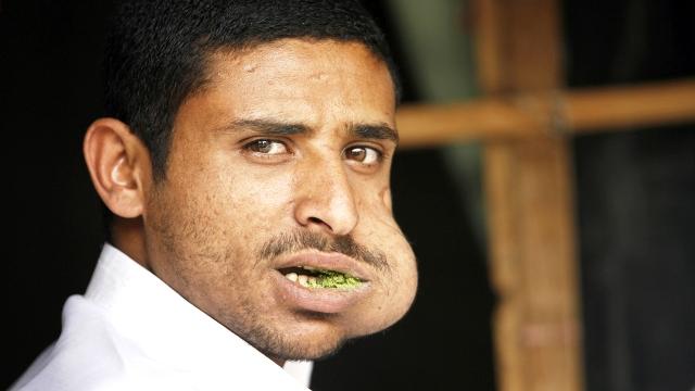 yemeni with large khat wad in mouth